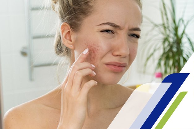 Mulher jovem observando seu reflexo no espelho enquanto toca o rosto, ilustrando a preocupação com espinha na adolescência.