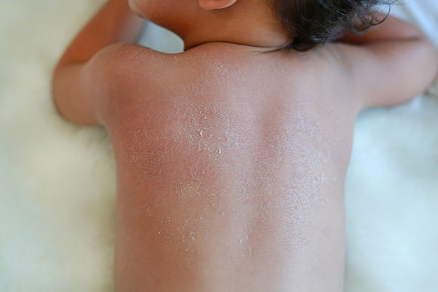 Criança deitada de costas mostrando a pele do bebê ressecada, com descamação visível e textura áspera na região dos ombros e costas.