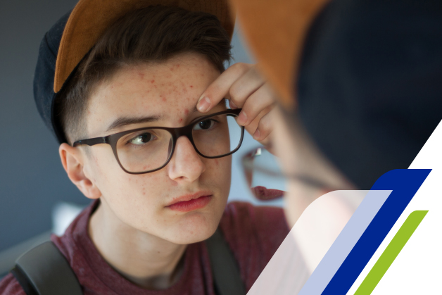 adolescente branco usando óculos de grau pretos vendo suas espinhas pelo espelho e pensando na necessidade de fazer limpeza de pele na adolescência